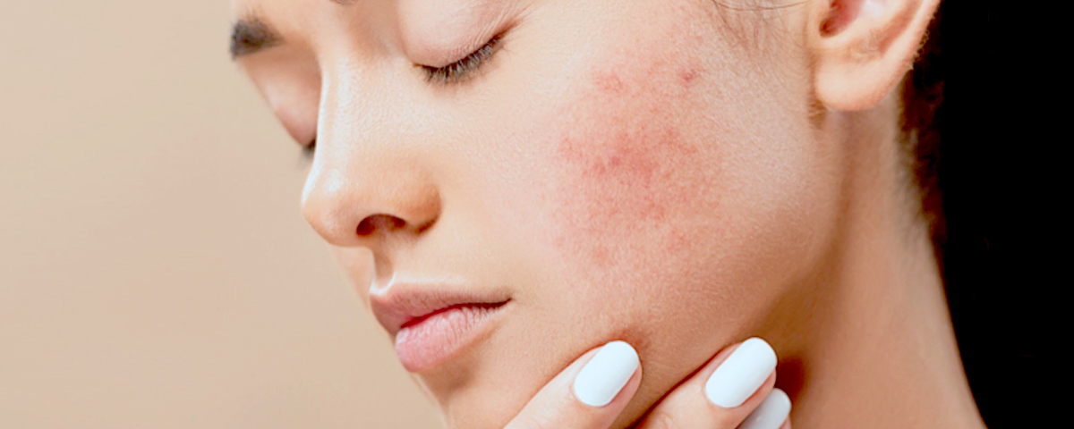 Acne Tardio Indermis